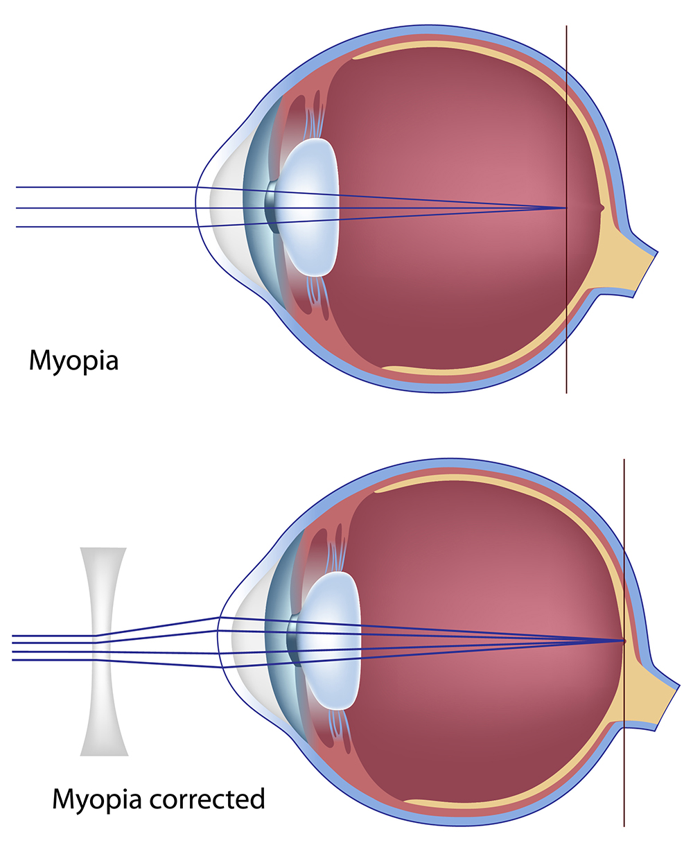 Eye Conditions